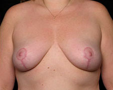 Breast Lift Results Southlake