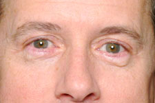 Eyelid Surgery Blepharoplasty Results Southlake