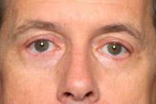 Eyelid Surgery Blepharoplasty Results Southlake