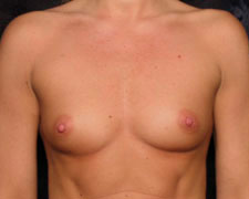 Breast Augmentation