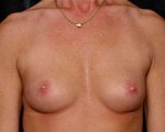 Breast Augmentation