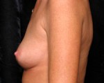 Breast Augmentation