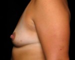 Breast Augmentation