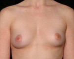 Breast Augmentation