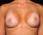 Breast Augmentation