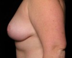 Breast Lift