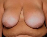 Breast Lift