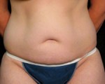 Abdominoplasty (Tummy Tuck)