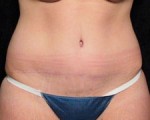 Abdominoplasty (Tummy Tuck)