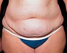 Abdominoplasty (Tummy Tuck)