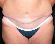 Abdominoplasty (Tummy Tuck)