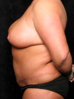 Mommy Makeover Before and After Gallery