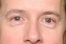 Blepharoplasty (Eyelid Surgery)