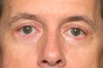 Blepharoplasty (Eyelid Surgery)