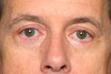 Blepharoplasty (Eyelid Surgery)