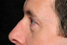 Blepharoplasty (Eyelid Surgery)