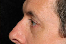 Blepharoplasty (Eyelid Surgery)