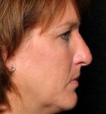 Rhinoplasty (Nose Surgery)