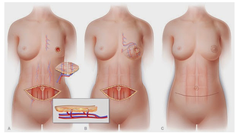 Autologous-Based Reconstruction