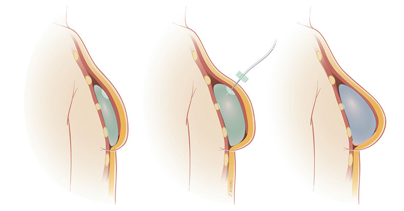 Implant-Based Reconstruction