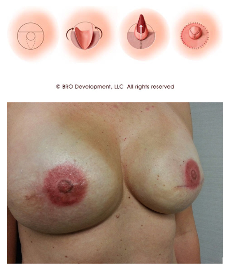 Nipple Reconstruction