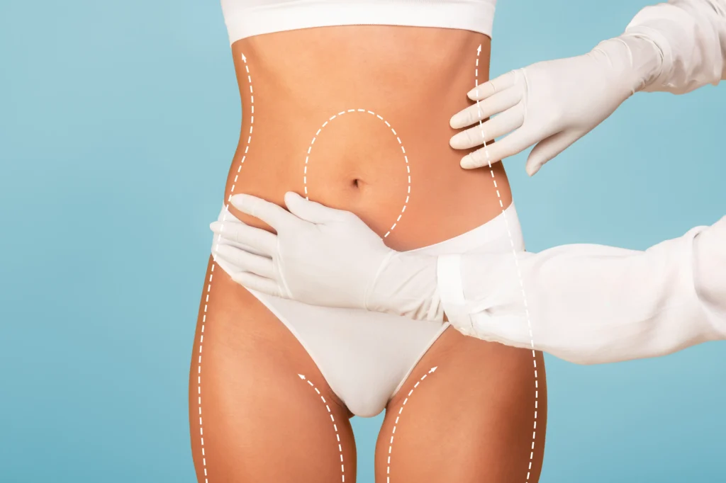 Liposuction body contouring procedure on abdomen and thighs