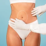 Liposuction body contouring procedure on abdomen and thighs