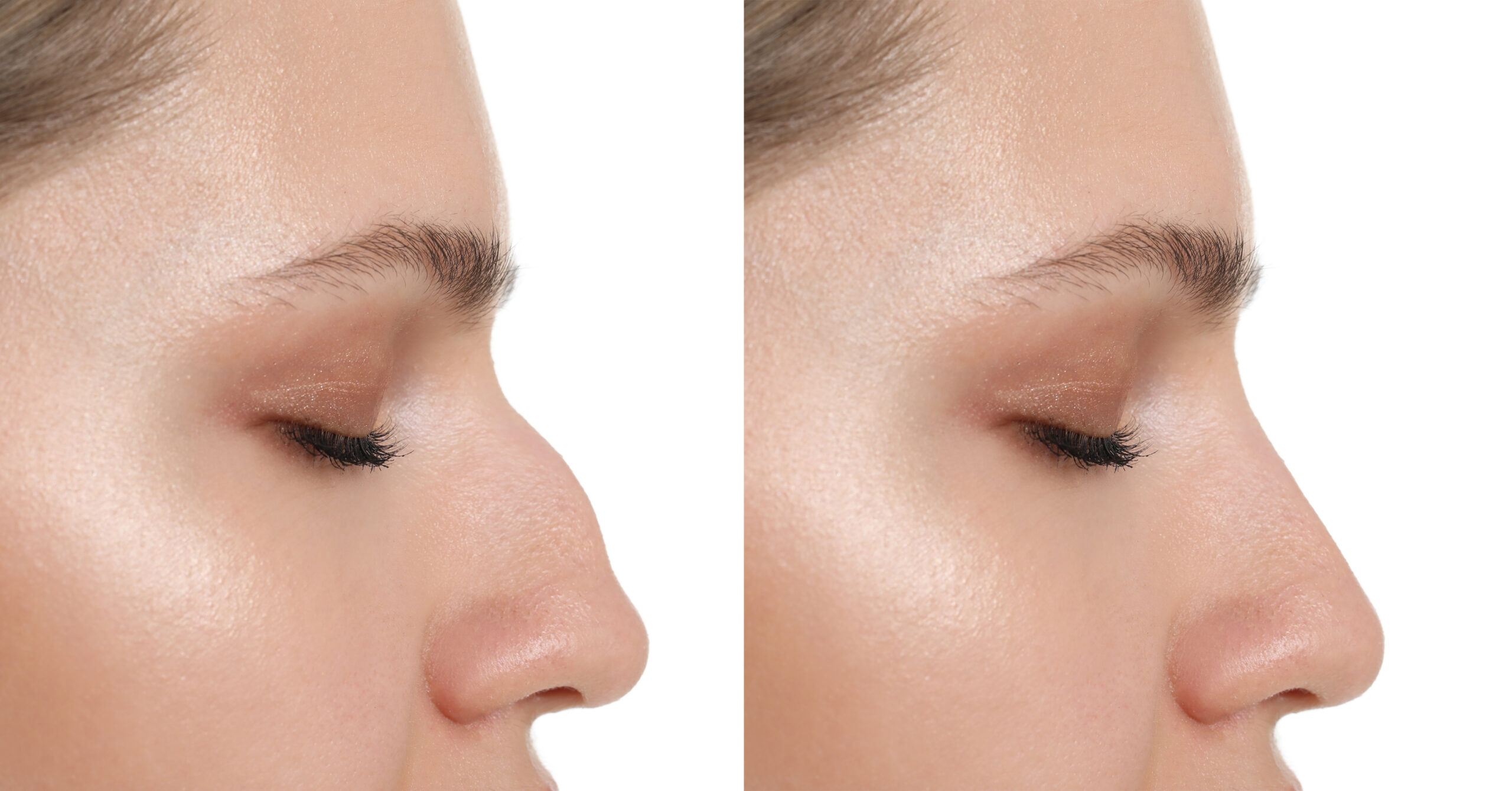 blepharoplasty